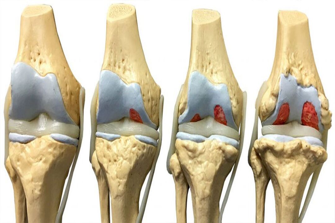 stages of the development of osteoarthritis