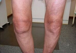 How to treat osteoarthritis of the knee joint