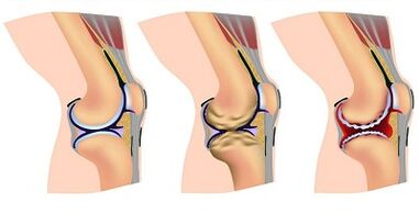Stages of osteoarthritis of the knee joint